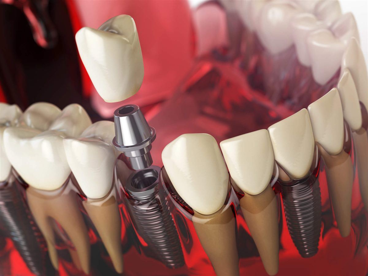 Common Medical Concerns That Delay Dental Implant Approval
