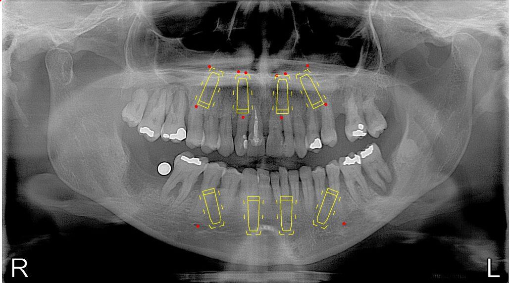 All-On-4 — Case 1 — case 1