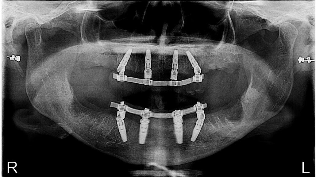 All-On-4 — Case 1 — case 2