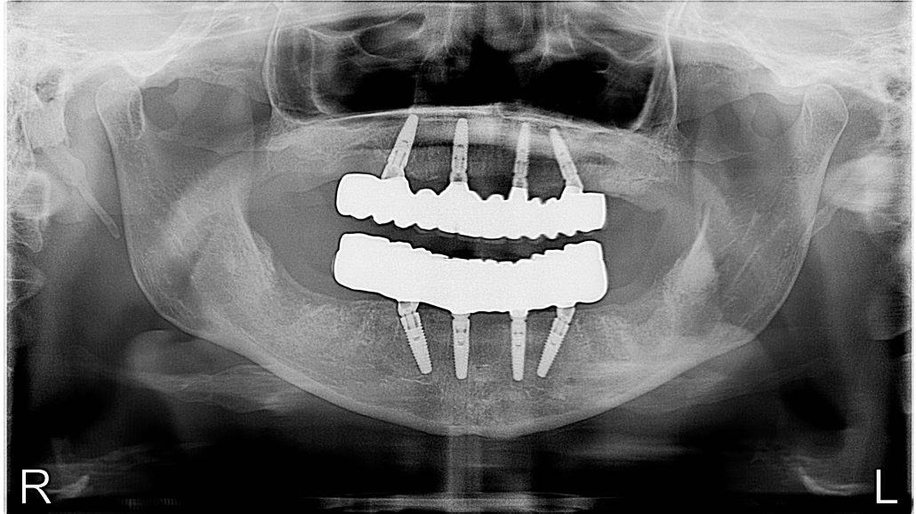 All-On-4 — Case 1 — case 5