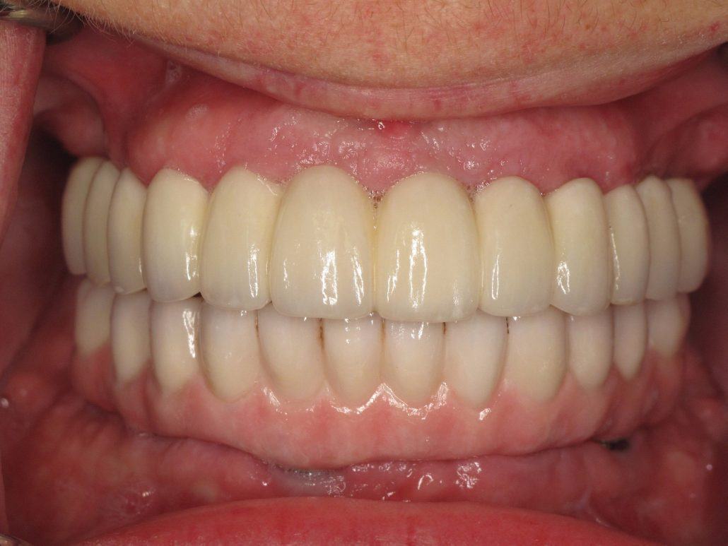 All-On-4 — Case 1 — case 6
