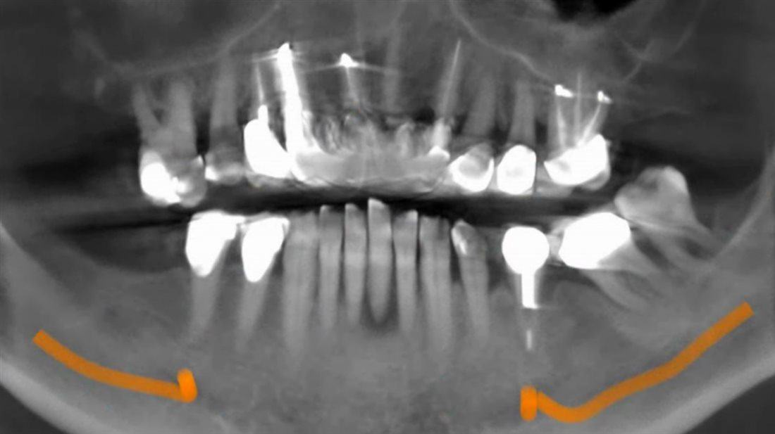 All-On-4 — Case 2 — case 1