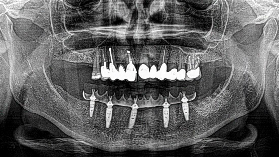 All-On-4 — Case 2 — case 2