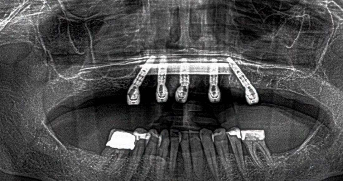 All-On-4 — Case 3 — case 1