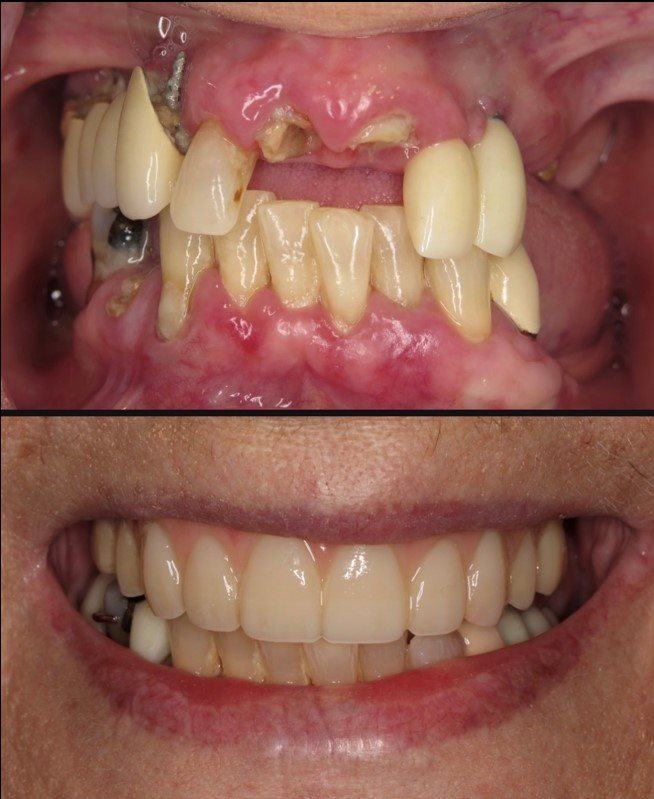 All-On-4 — Case 4 — case 1