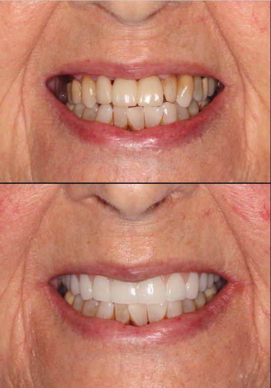 All-On-4 — Case 3 — case 2