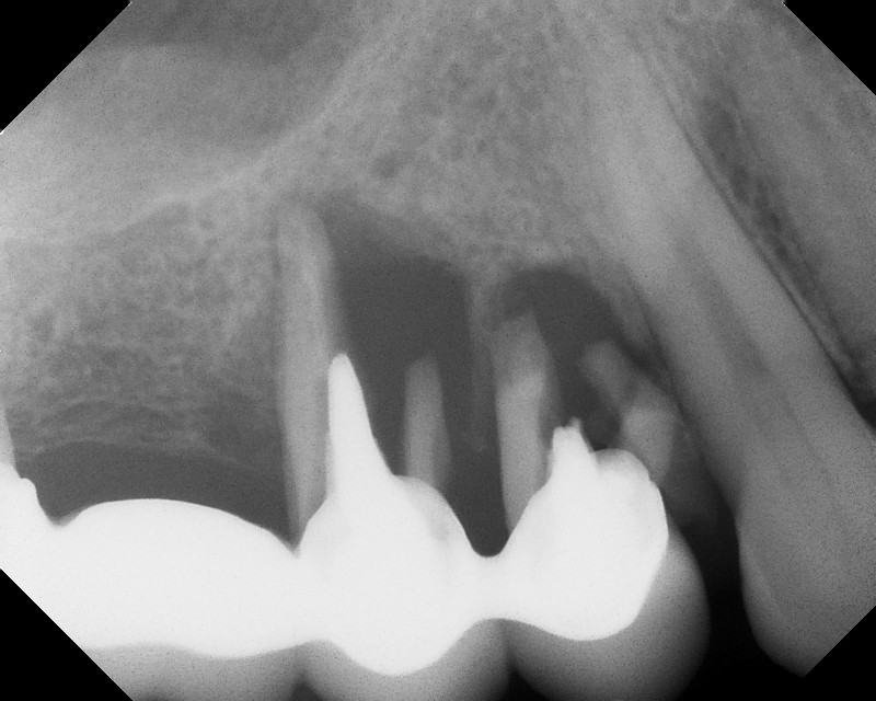 Bone Grafting and Implants — Case 1 — case 1
