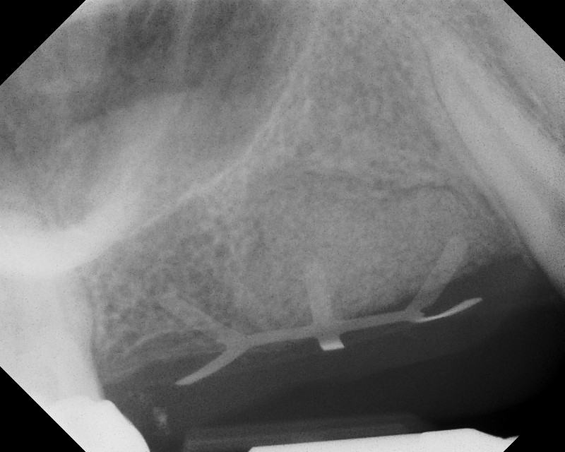 Bone Grafting and Implants — Case 1 — case 2