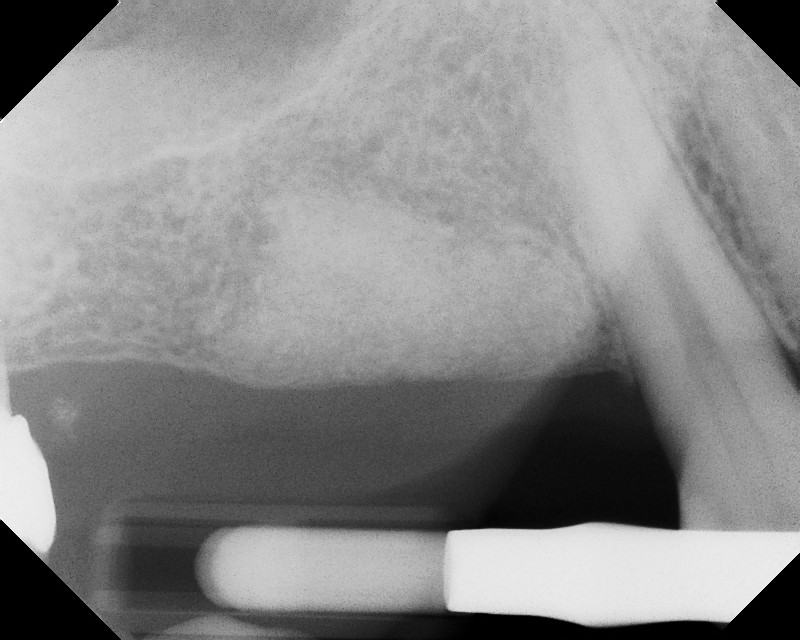 Bone Grafting and Implants — Case 1 — case 3