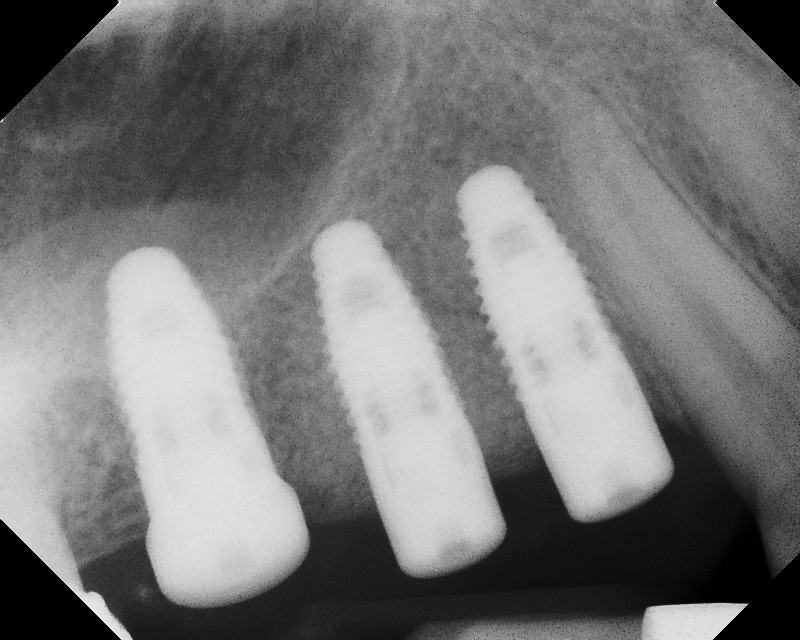 Bone Grafting and Implants — Case 1 — case 4