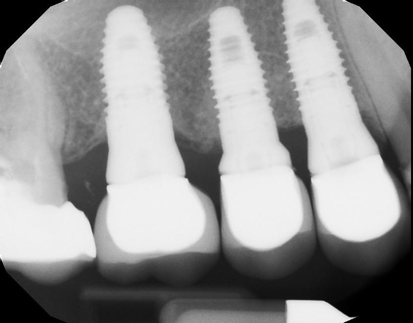 Bone Grafting and Implants — Case 1 — case 5