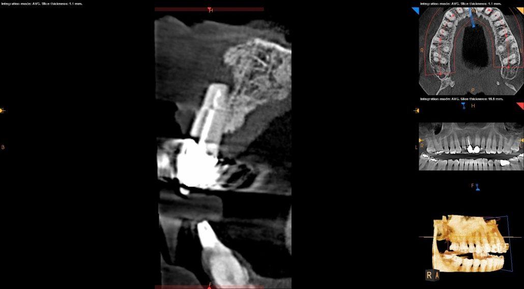 Bone Grafting and Implants — Case 2 — case 1