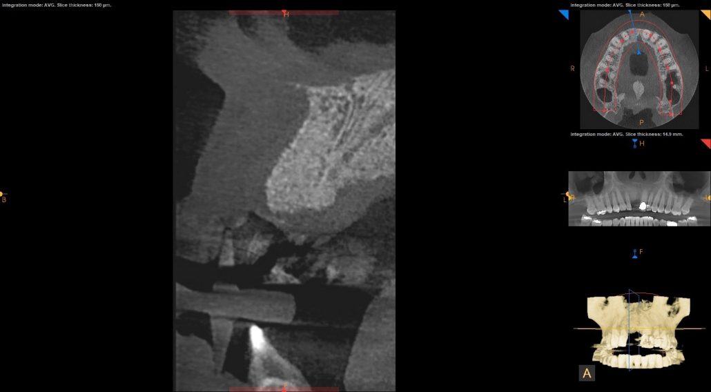 Bone Grafting and Implants — Case 2 — case 2