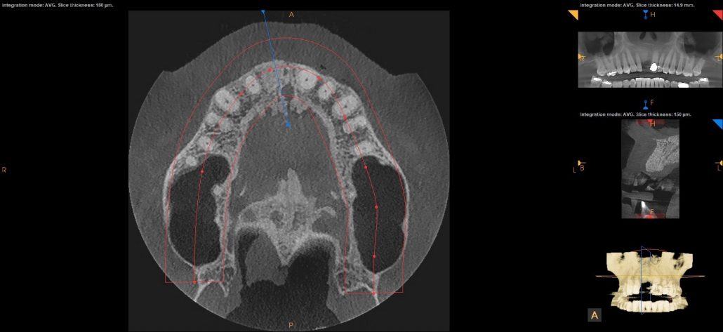 Bone Grafting and Implants — Case 2 — case 3