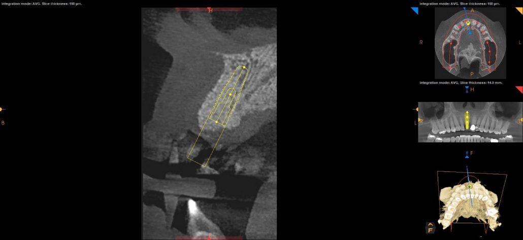 Bone Grafting and Implants — Case 2 — case 4