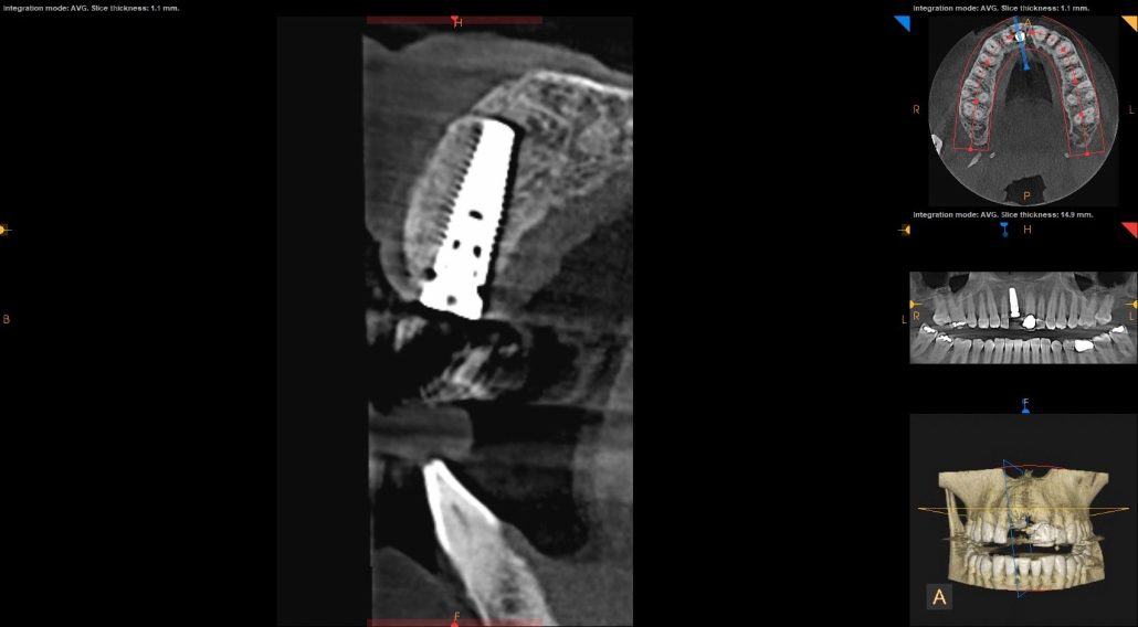 Bone Grafting and Implants — Case 2 — case 5