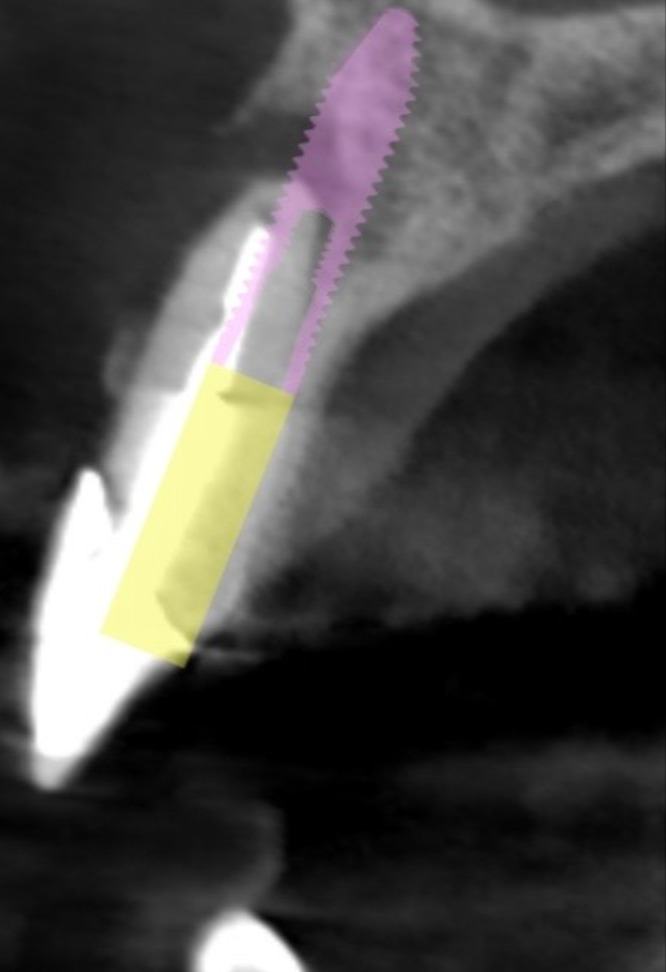 Bone Grafting and Implants — Case 3 — case 1