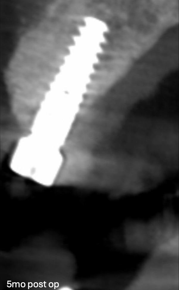 Bone Grafting and Implants — Case 3 — case 2