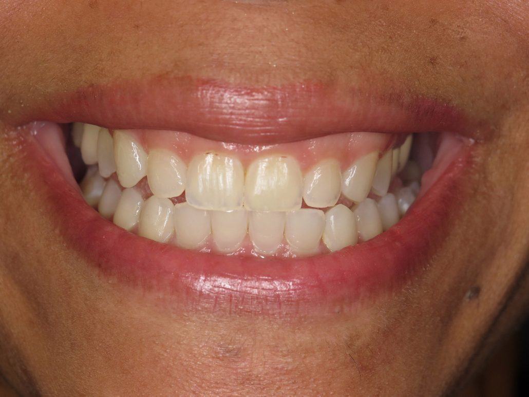 Cosmetic Crown Lengthening — Case 1 — case 1