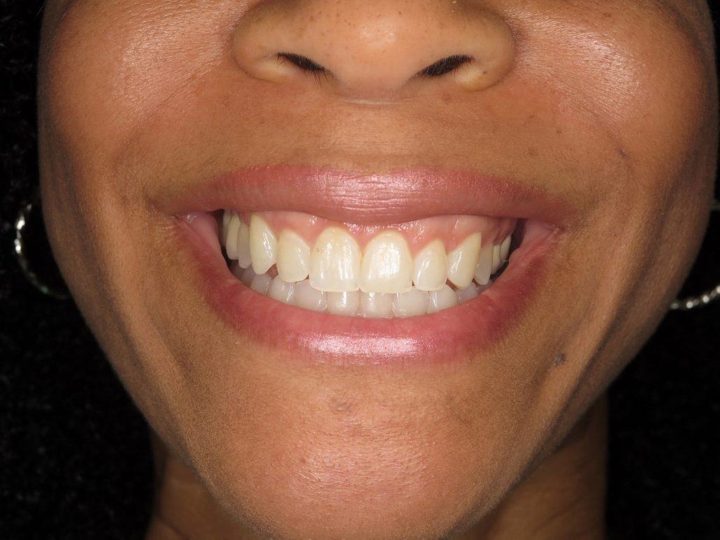 Cosmetic Crown Lengthening — Case 1 — case 2