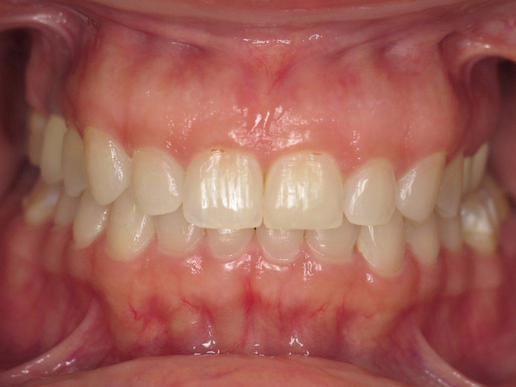 Cosmetic Crown Lengthening — Case 1 — case 3