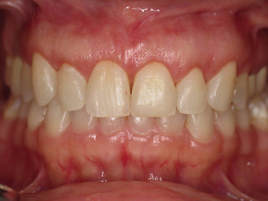 Cosmetic Crown Lengthening — Case 1 — case 4