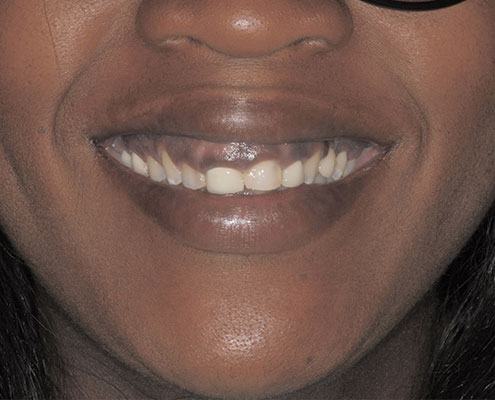 Gummy Smile → Crown Lengthening — before