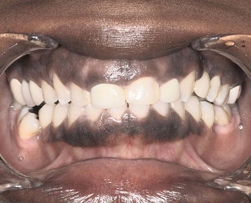 Cosmetic Crown Lengthening — Case 2 — case 2