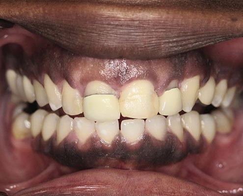 Cosmetic Crown Lengthening — Case 2 — case 3