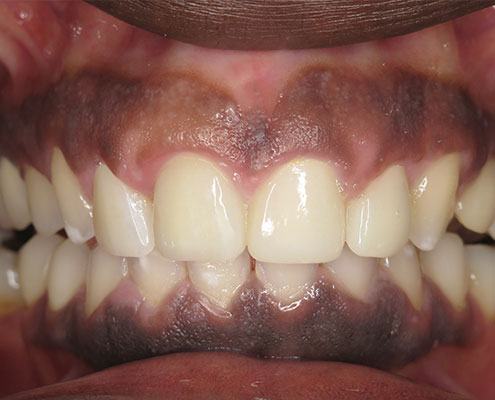Cosmetic Crown Lengthening — Case 2 — case 4