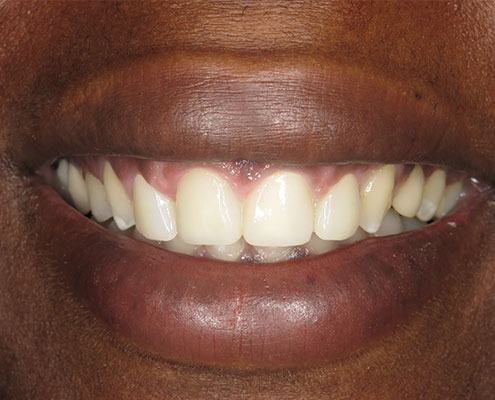 Cosmetic Crown Lengthening — Case 2 — case 5