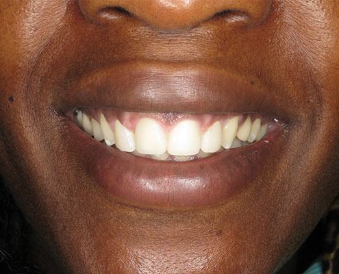 Gummy Smile → Crown Lengthening — after