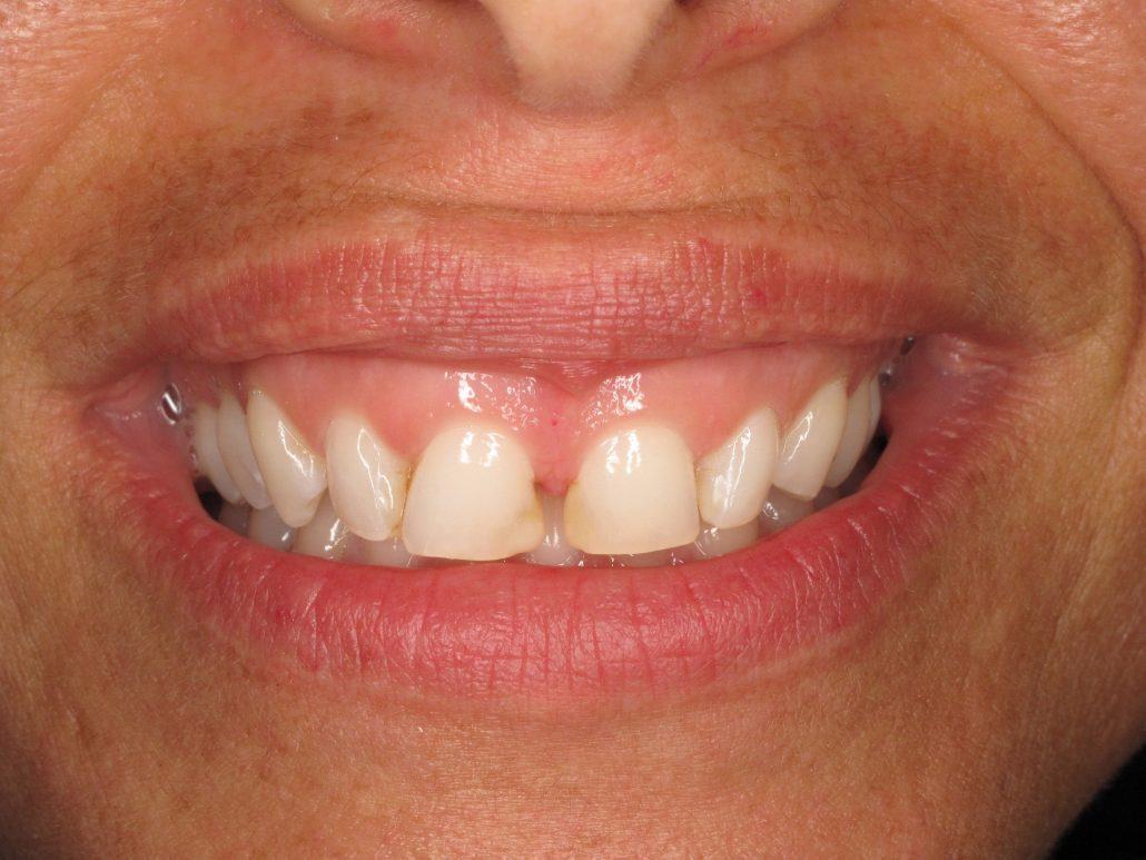 Cosmetic Crown Lengthening — Case 3 — case 1