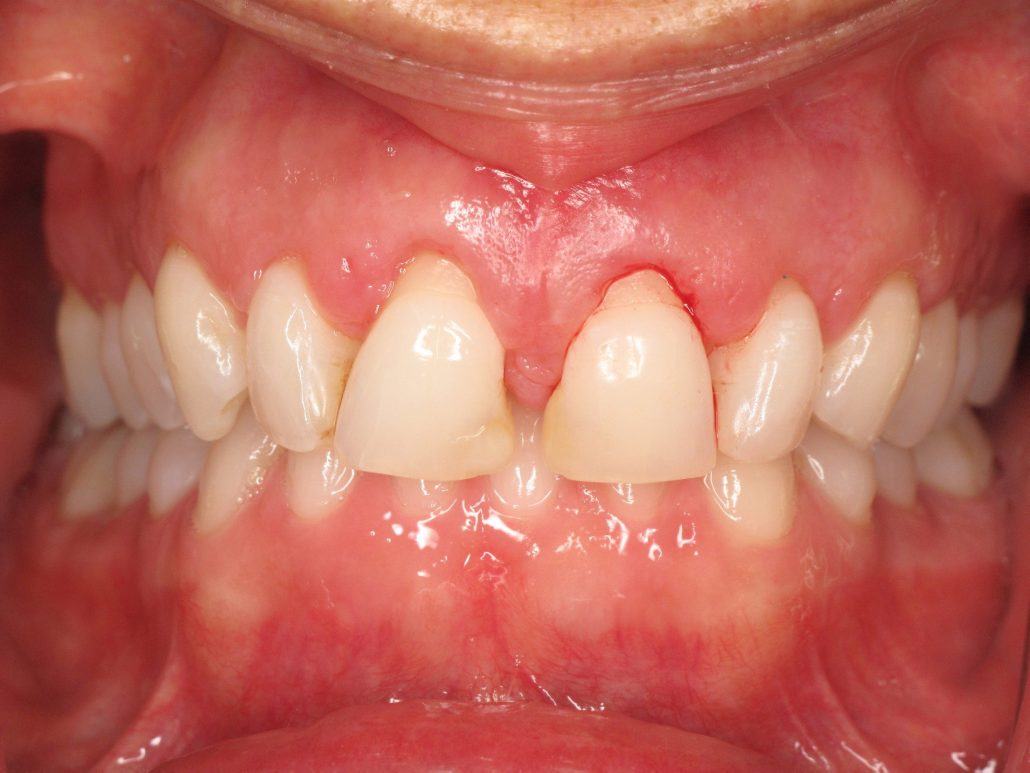 Cosmetic Crown Lengthening — Case 3 — case 2