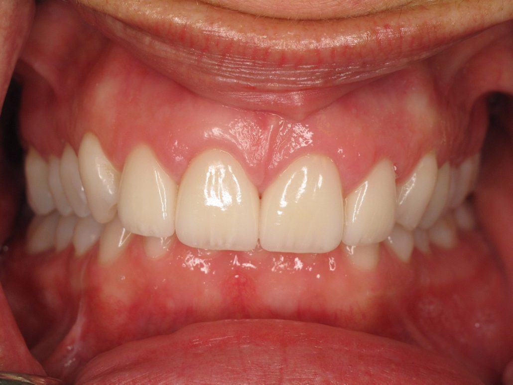 Cosmetic Crown Lengthening — Case 3 — case 3