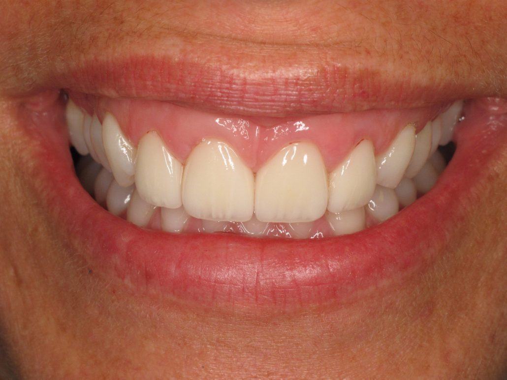 Cosmetic Crown Lengthening — Case 3 — case 4