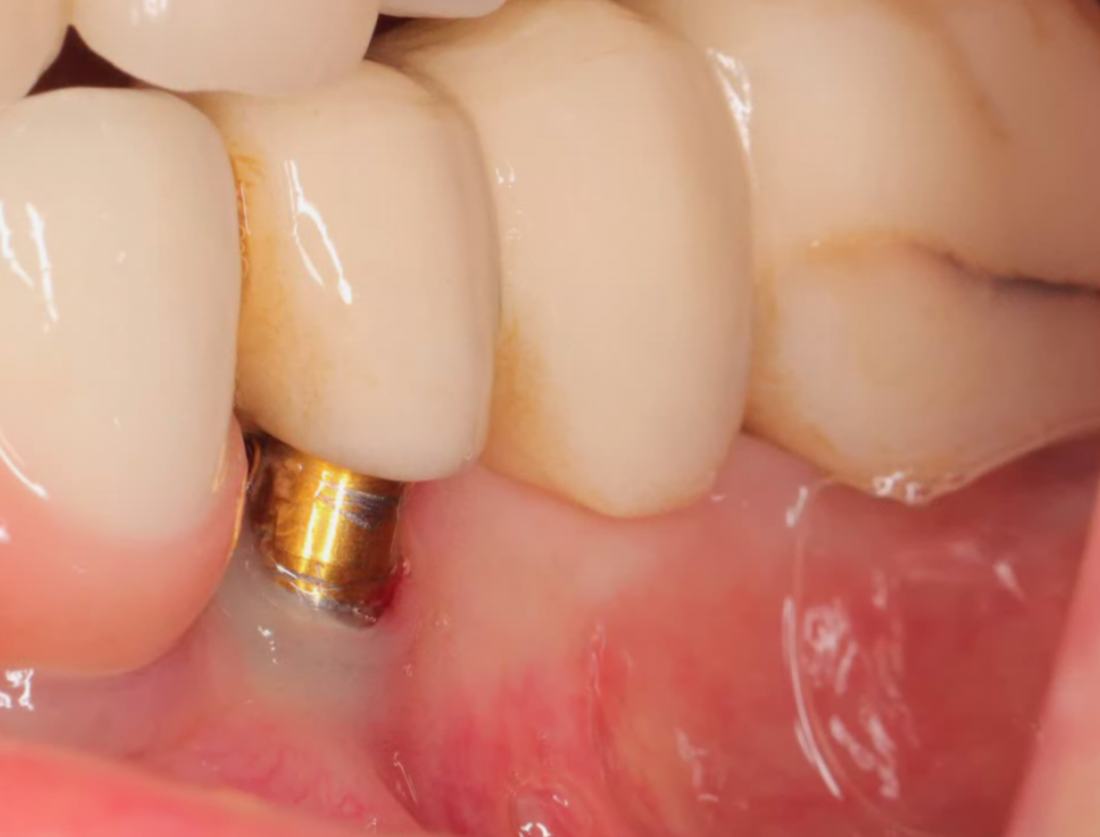 Gum Grafting Around Implants — Case 1 — case 1