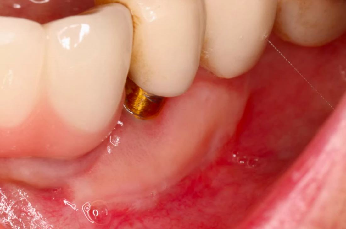 Gum Grafting Around Implants — Case 1 — case 2
