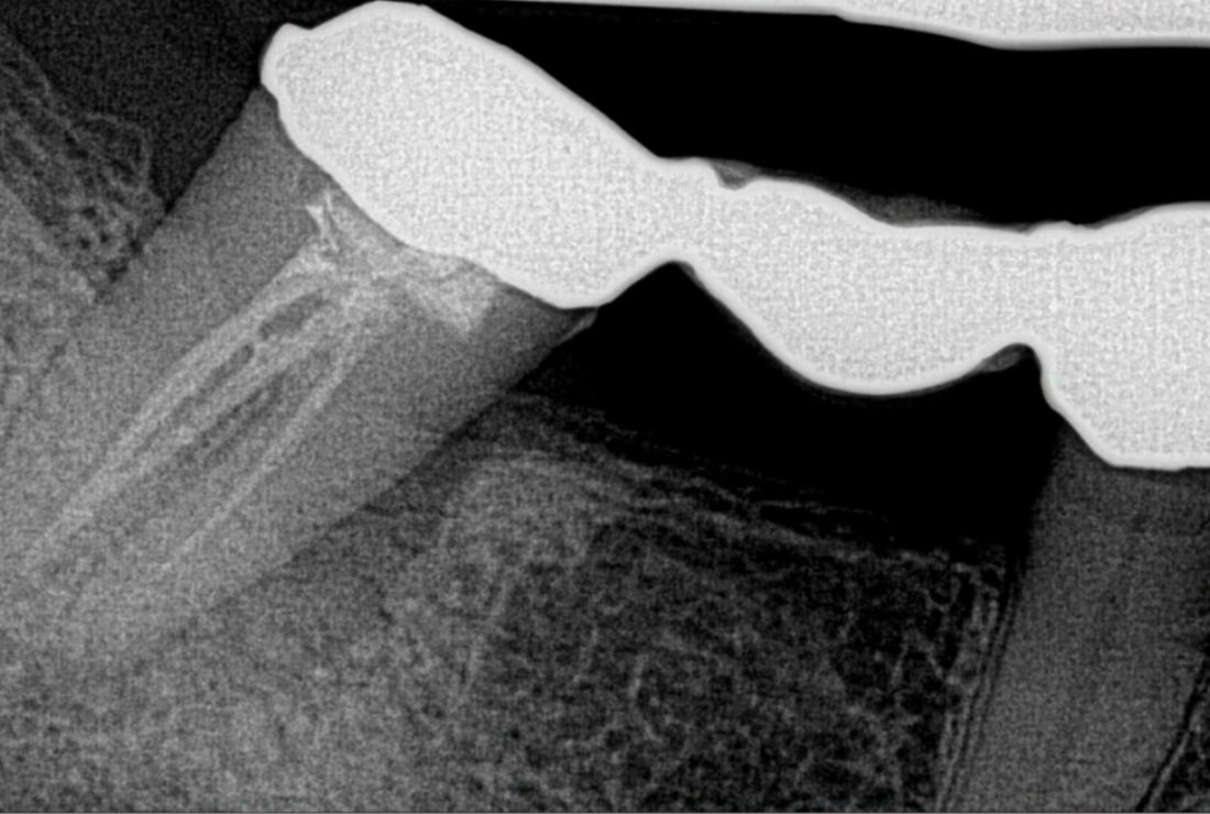 Failing Bridge → Immediate Implant Placement — before