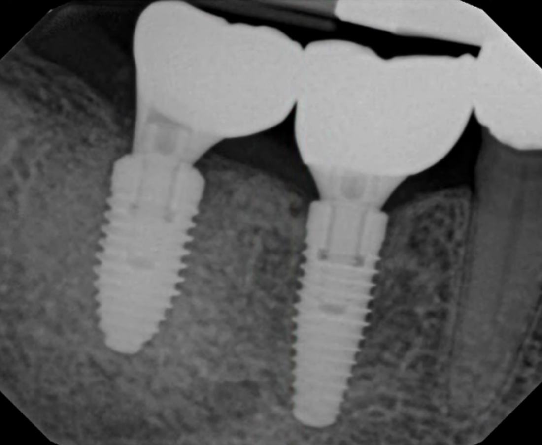 Failing Bridge → Immediate Implant Placement — after