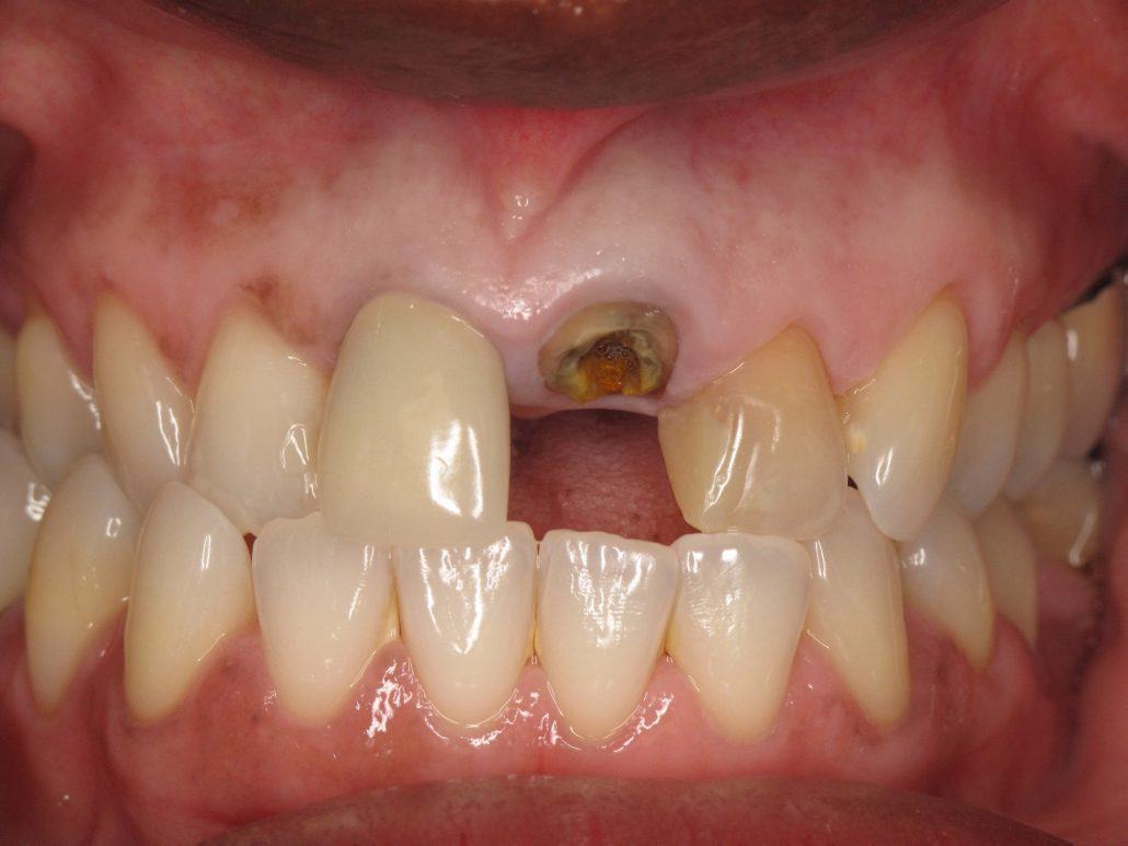 Immediate Implant Placement — Case 1 — case 1