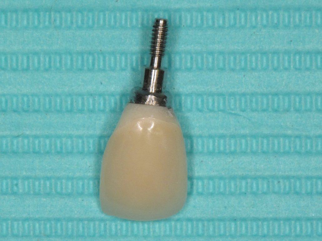 Immediate Implant Placement — Case 1 — case 2