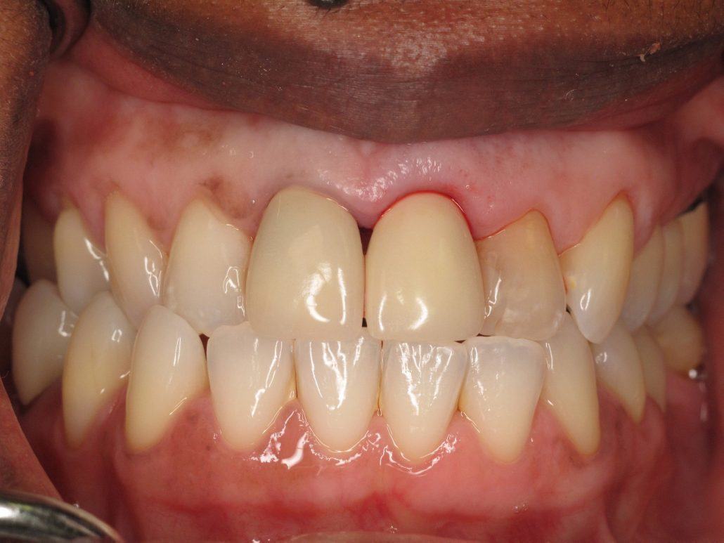 Immediate Implant Placement — Case 1 — case 3