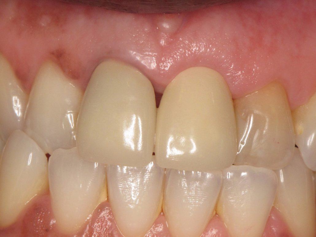 Immediate Implant Placement — Case 1 — case 4