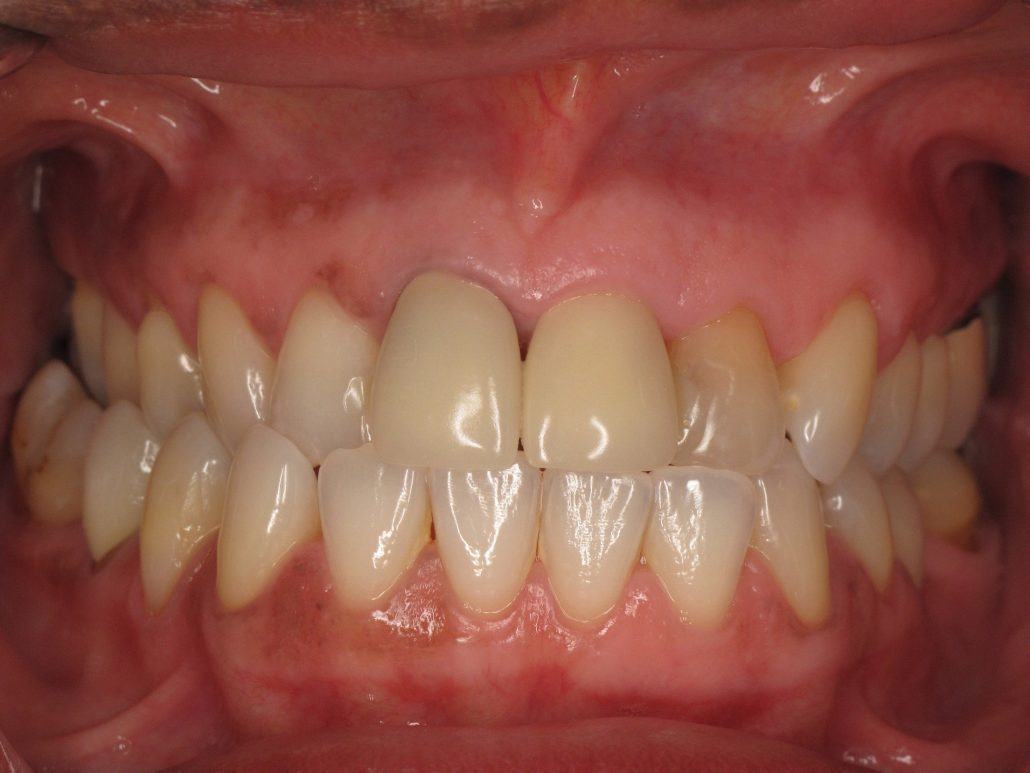 Immediate Implant Placement — Case 1 — case 5