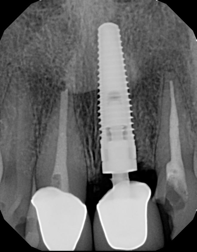 Immediate Implant Placement — Case 1 — case 6