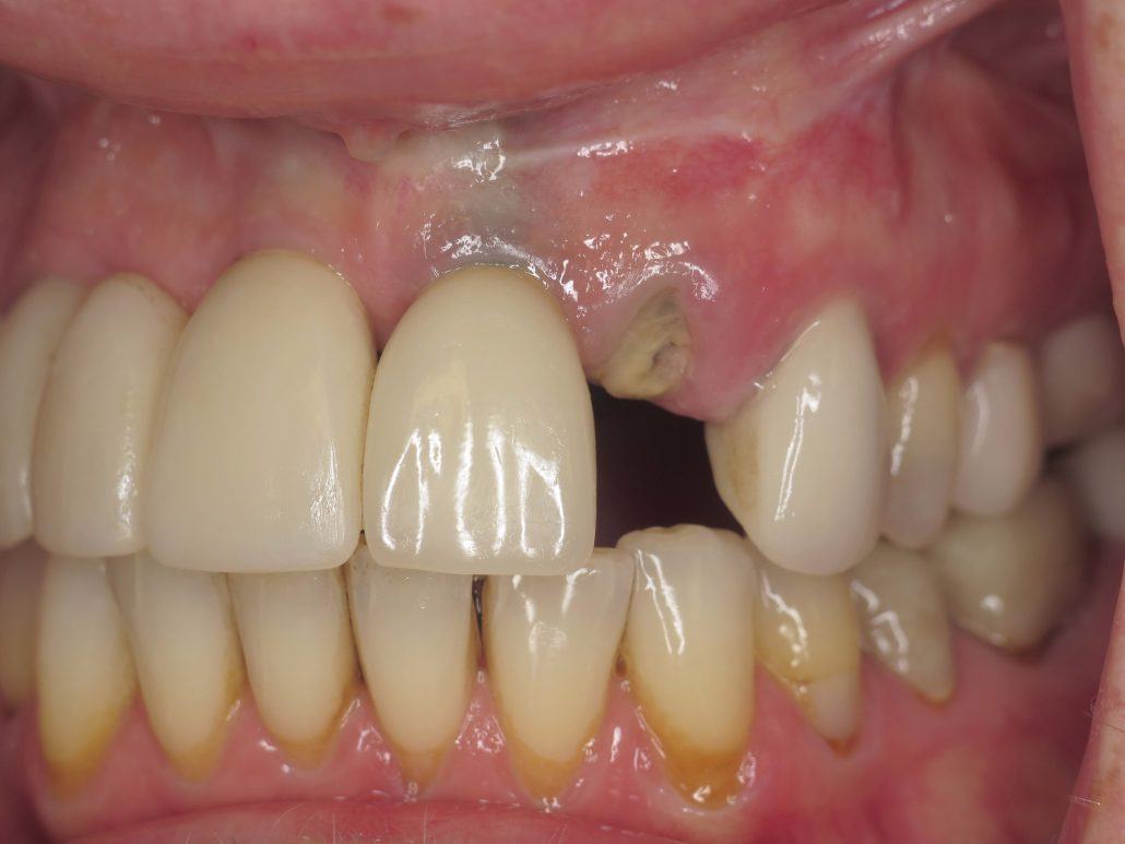 Immediate Implant Placement — Case 2 — case 1