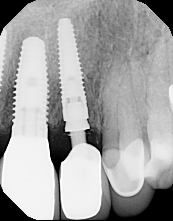 Immediate Implant Placement — Case 2 — case 2