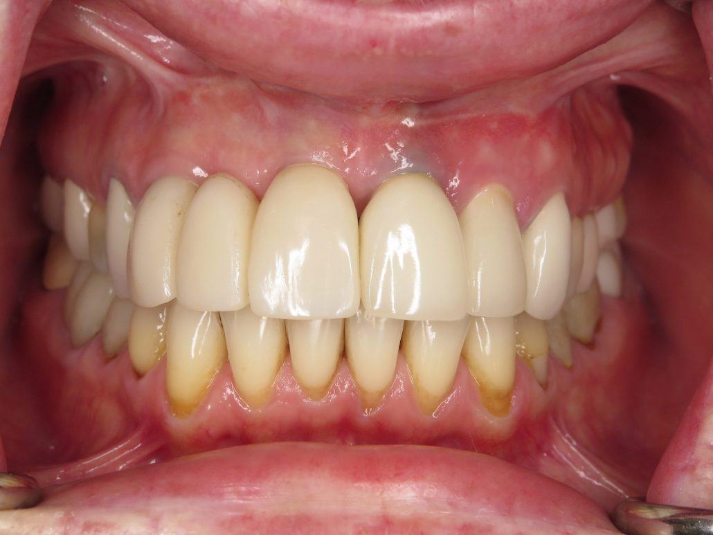 Immediate Implant Placement — Case 2 — case 3