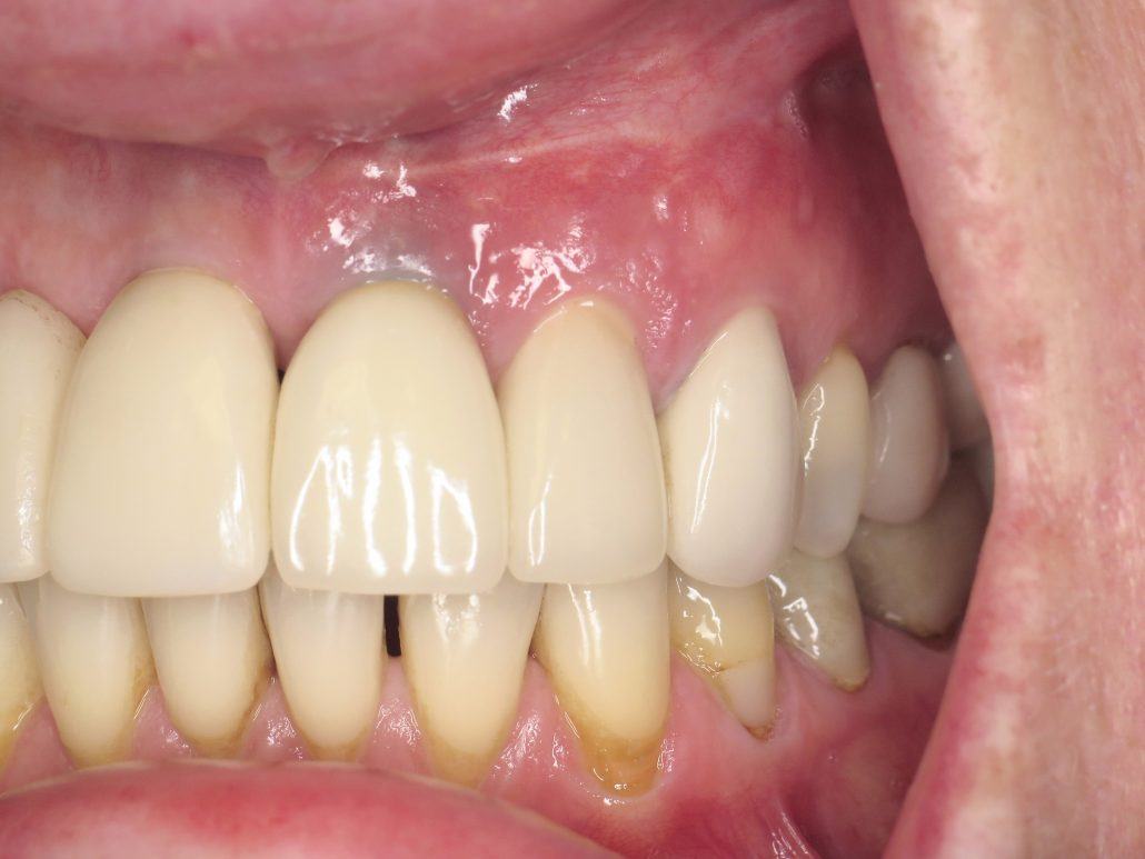 Immediate Implant Placement — Case 2 — case 4